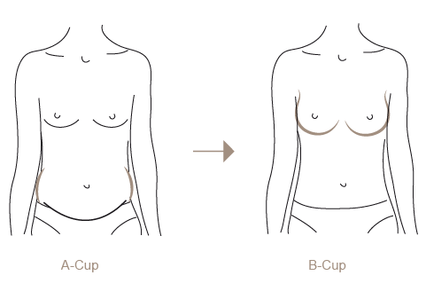 Brustvergrößerung mit Eigenfett 