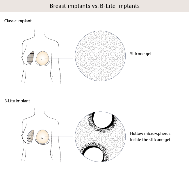 Brustimplantate vs. B-Lite-Implantate, Nürnberger Klinik, Dr. Baetge 
