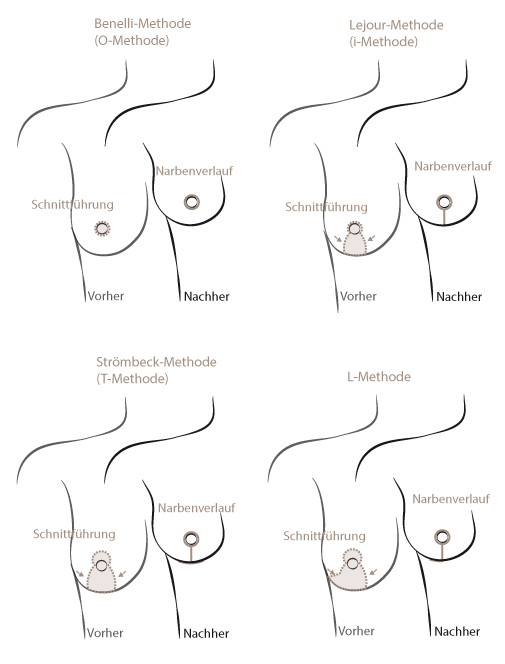 Brustverkleinerung Techniken 