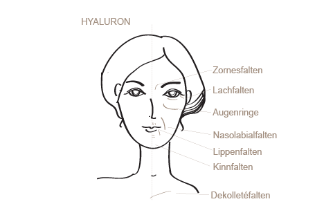 Faltenunterspritzung mit Hyaluronsäure
