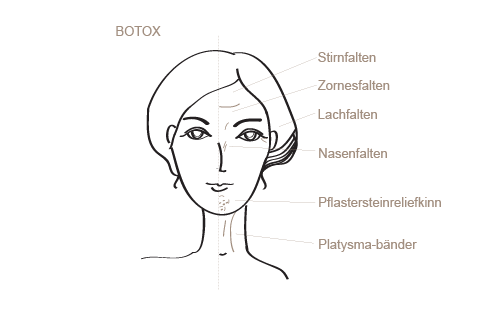 Faltenbehandlung mit Botox®