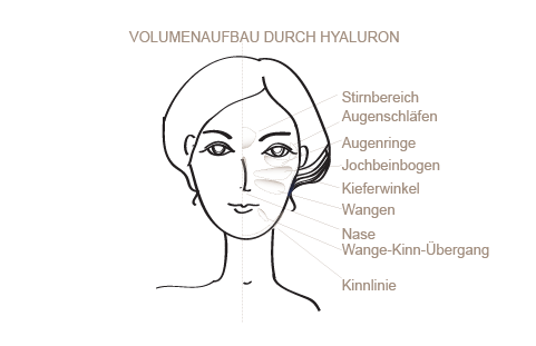 Volumenaufbau mittels Hyaluronsäure 