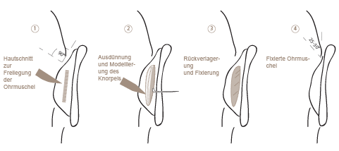 Ohren anlegen in der Nürnberger Klinik - Vorgehensweise 