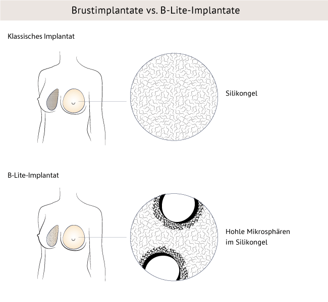 Brustimplantate vs. B-Lite-Implantate, Nürnberger Klinik, Dr. Baetge 