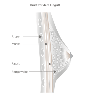 Brust vor Eingriff 