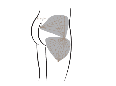 Grafik Fettabsaugung Oberflächen Liposuktion 