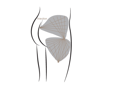 Grafik Fettabsaugung Oberflächen Liposuktion