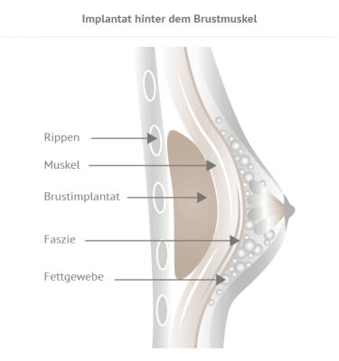 Grafik hinter Brustmuskel
