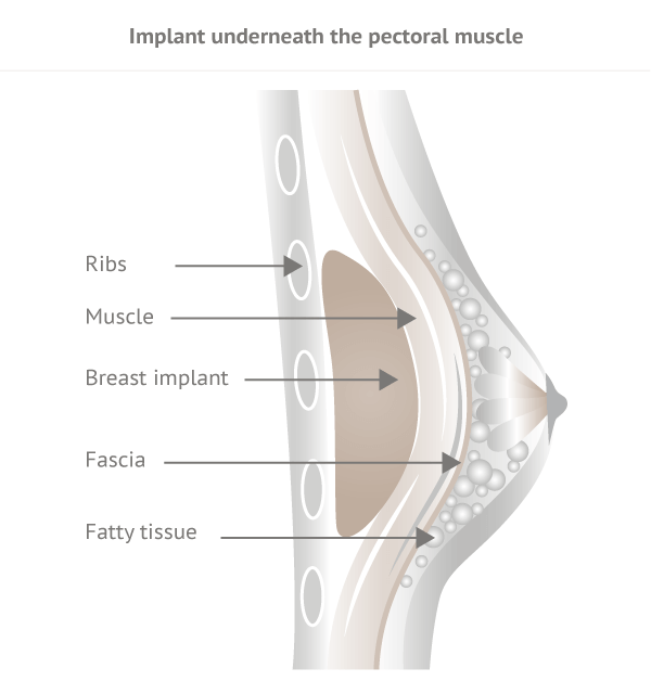 Grafik hinter Brustmuskel 