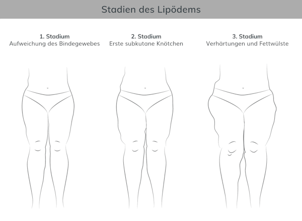 Stadien Lipödem